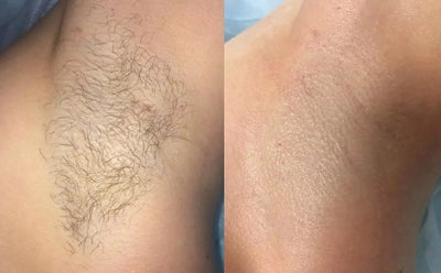 Underarms