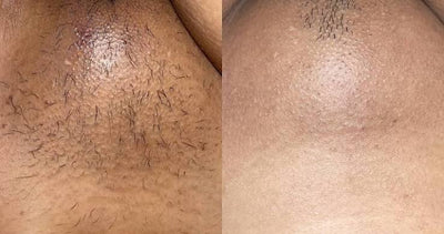 Underarms