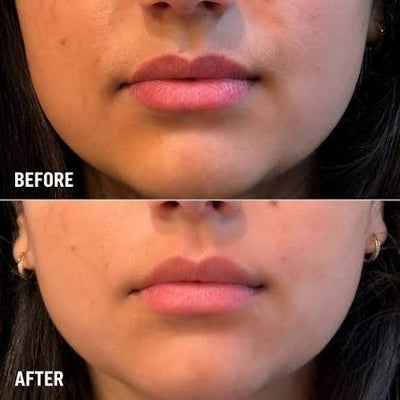 Upper Lip