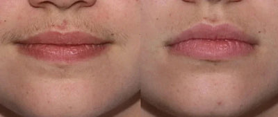 Upper Lip