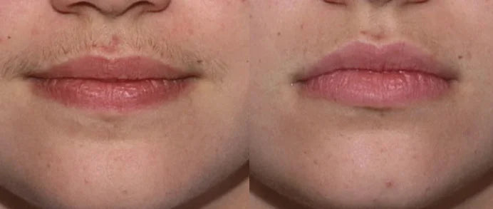 Upper Lip
